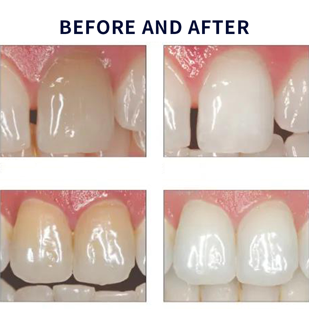 Opalescencia blanqueadora 20%  - Teeth Whitening Doctor reseña y precio