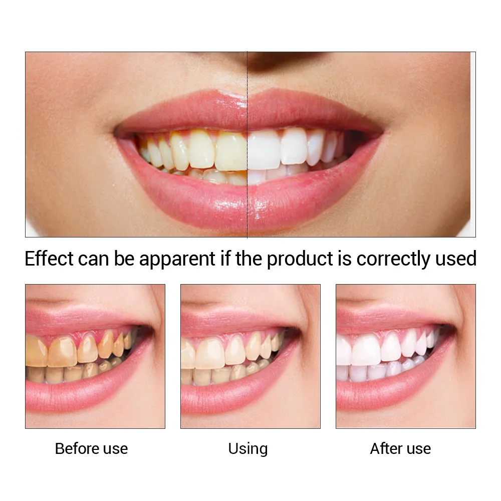 FTEENPLY-esencia para blanquea - Teeth Whitening Levels reseña y precio